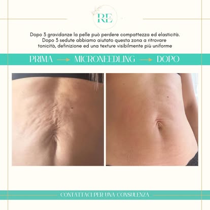 Caso reale — Microneedling addome dopo 3 gravidanze, 3 sedute
